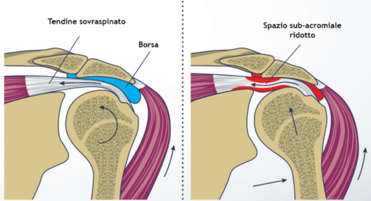 impingement spalla